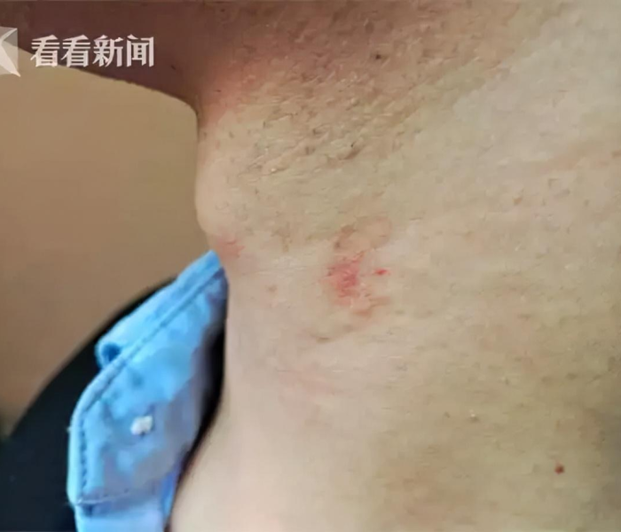 女人长猴节咋回事:女人有猴结是正常吗