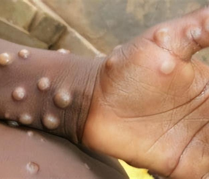 猴痘患者图片/猴痘患者图片大全