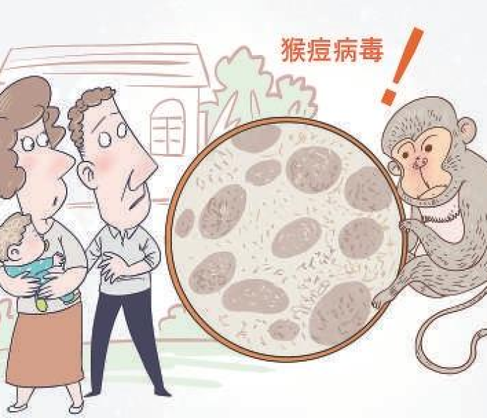 【猴痘病毒是什么样子/猴痘病毒的临床症状】