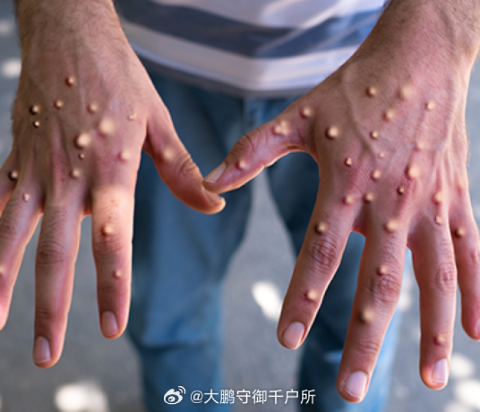 全球已发现约80例猴痘病例多少（全球已发现约80例猴痘病例多少例）