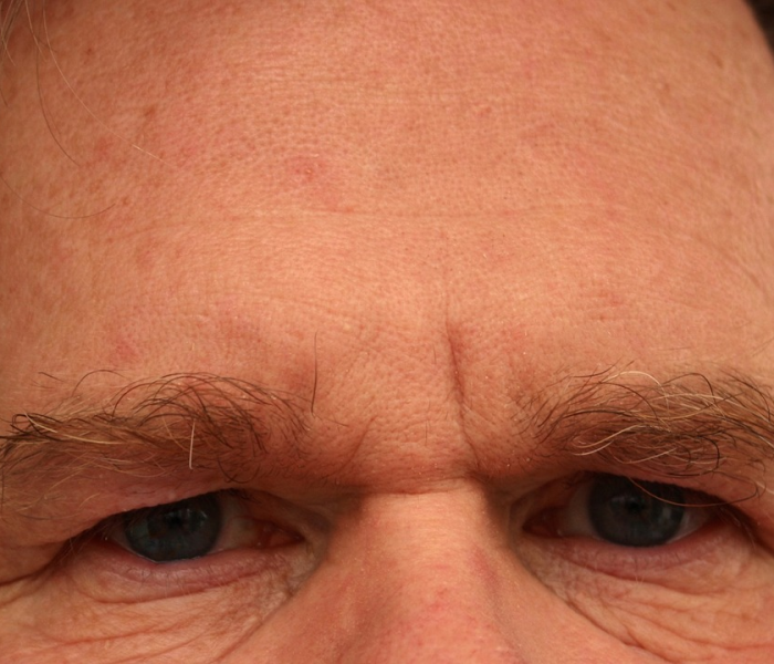 二次感染有哪些症状表现（二次感染会自愈吗）